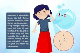  PHÒNG, CHỐNG BỆNH THAN NHỮNG ĐIỀU CẦN BIẾT